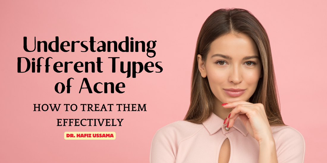 Understanding Different Types of Acne and How to Treat them Effectively