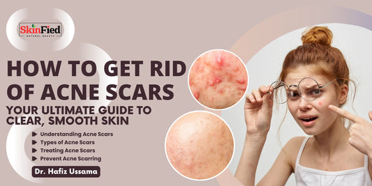 How to Get Rid of Acne Scars: Your Ultimate Guide to Clear, Smooth Skin Acne Clear Oil Controller Lotion Price in Pakistan