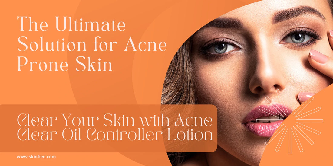 Clear Your Skin with Acne Clear Oil Controller Lotion